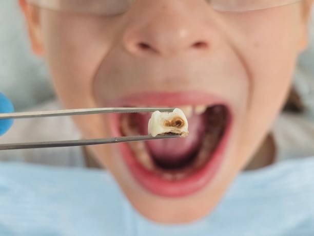 Best Emergency Dental Care for Broken or Chipped Teeth in Farmington, IL